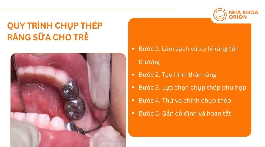 Quy tr&igrave;nh 5 bước chụp th&eacute;p răng sữa cho trẻ