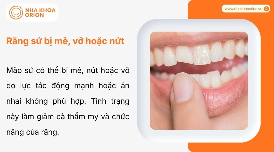 M&atilde;o sứ nứt vỡ do lực nhai mạnh, cần thay mới để bảo vệ răng thật