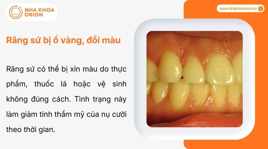 Răng sứ bị xỉn m&agrave;u cần thay mới để cải thiện thẩm mỹ