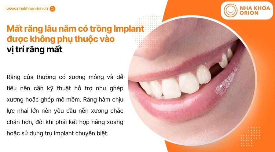 Vị tr&iacute; răng mất ảnh hưởng đến mức độ ti&ecirc;u xương v&agrave; kỹ thuật phục h&igrave;nh cần &aacute;p dụng
