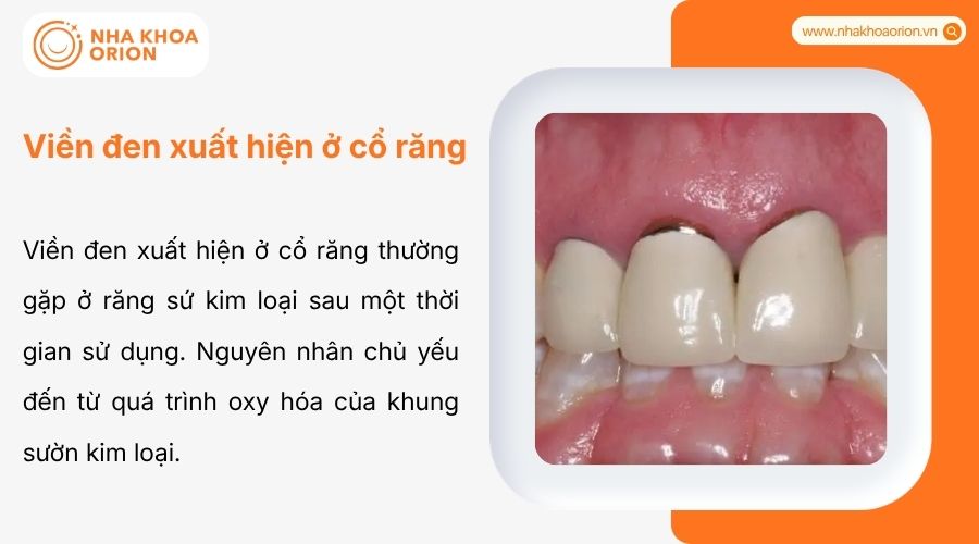 Viền đen cổ răng do oxy h&oacute;a răng sứ kim loại, ảnh hưởng thẩm mỹ