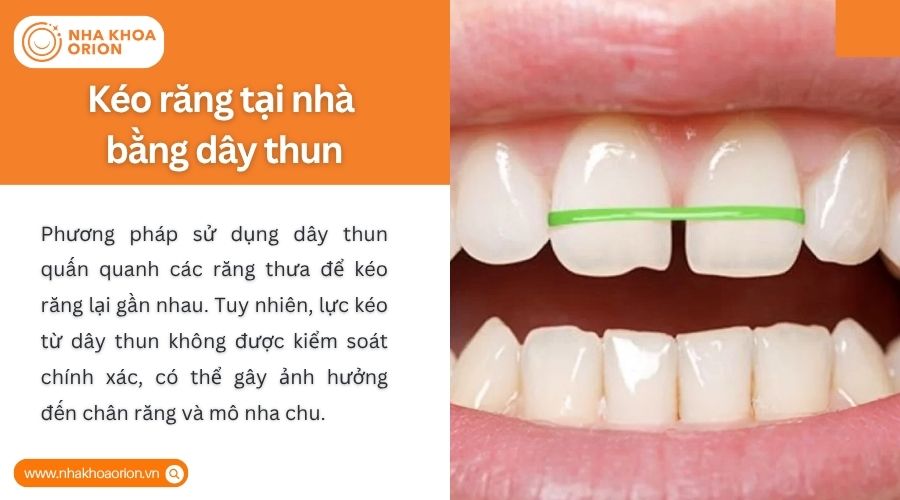D&acirc;y thun k&eacute;o răng tại nh&agrave; kh&ocirc;ng kiểm so&aacute;t lực, dễ g&acirc;y tổn thương răng v&agrave; m&ocirc; nha chu