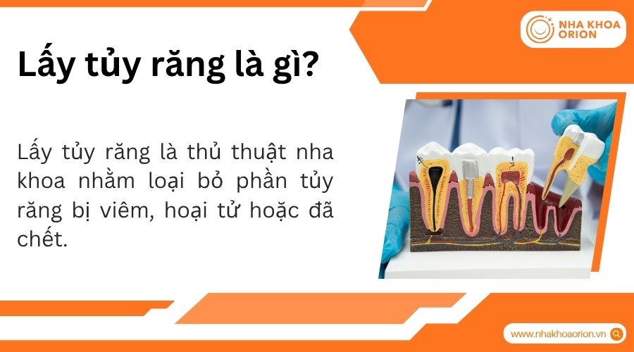 Lấy tủy gi&uacute;p loại bỏ vi&ecirc;m nhiễm v&agrave; bảo tồn răng thật hiệu quả l&acirc;u d&agrave;i