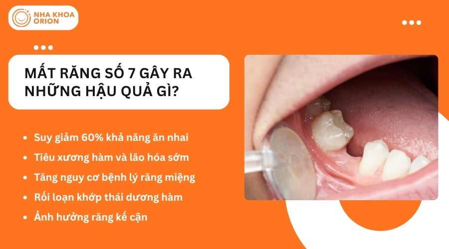 Mất răng số 7 gây ra những hậu quả gì