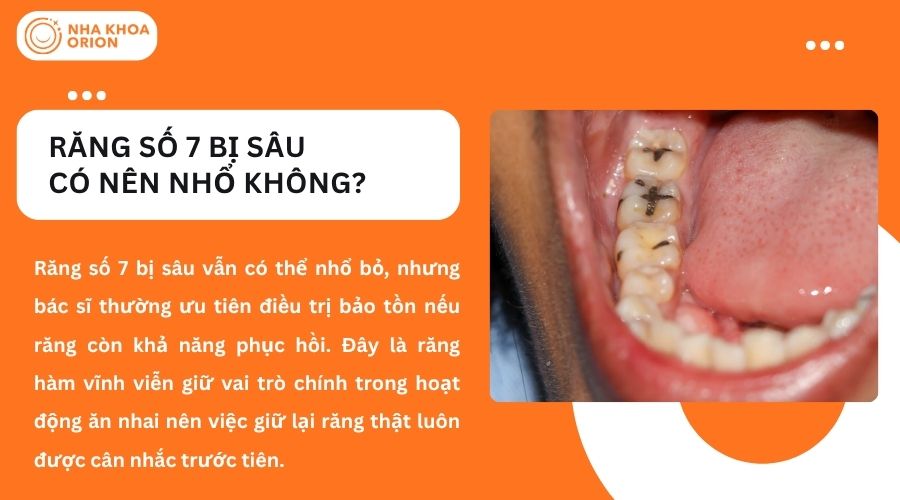Răng số 7 bị sâu có nên nhổ không?