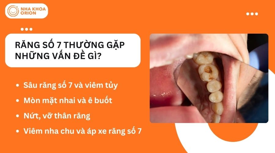 Răng số 7 dễ gặp sâu răng, nứt răng và áp xe nếu vệ sinh kém