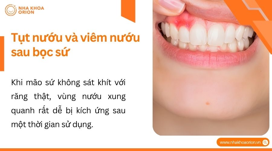 Mão sứ không sát khít dễ gây tụt nướu, viêm nha chu và chảy máu chân răng
