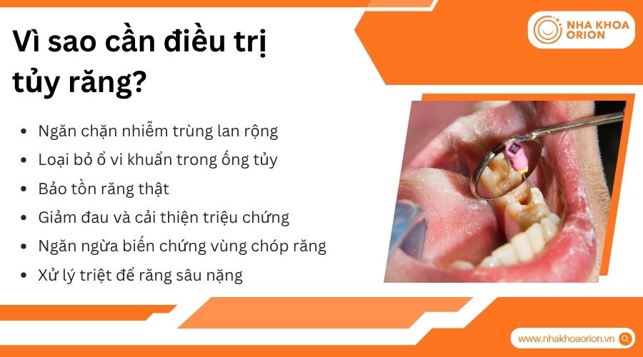 Điều trị tủy gi&uacute;p loại bỏ nhiễm tr&ugrave;ng v&agrave; bảo tồn răng thật hiệu quả l&acirc;u d&agrave;i