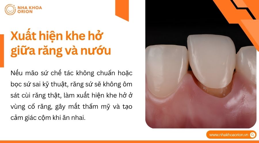 Răng sứ bọc sai kỹ thuật dễ gây hở cổ răng và viêm nướu kéo dài