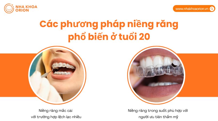 Các phương pháp niềng răng phổ biến ở tuổi 20