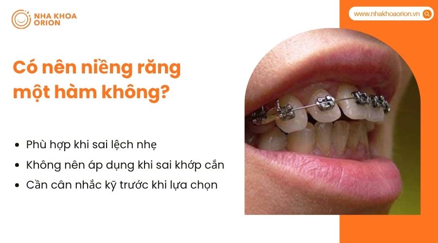 Có nên niềng răng một hàm không