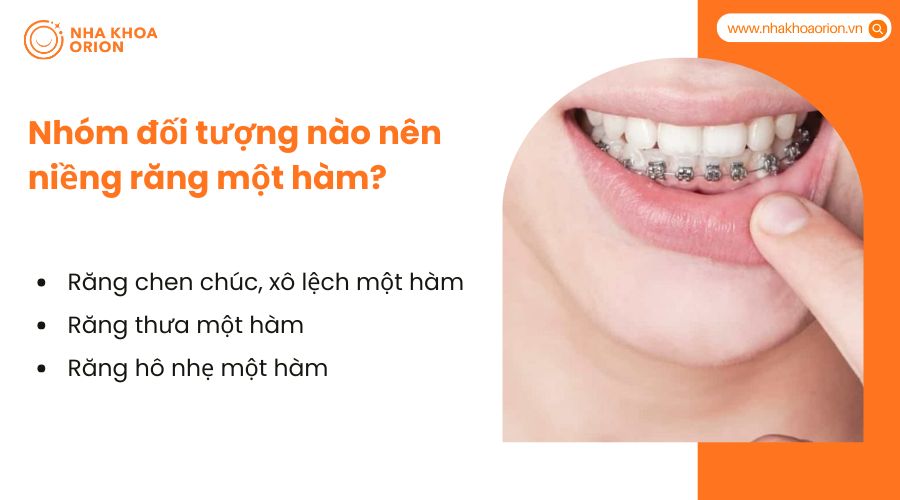 Nhóm đối tượng nào nên niềng răng một hàm