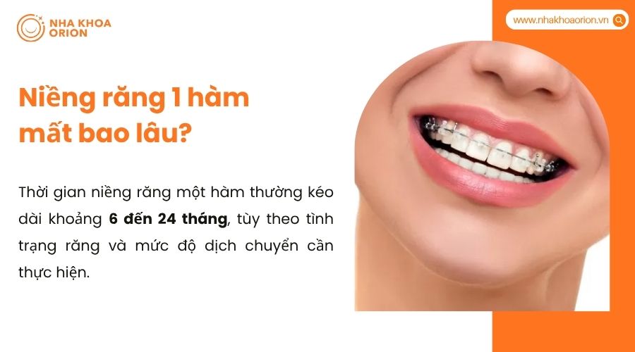 Niềng răng 1 hàm mất bao lâu
