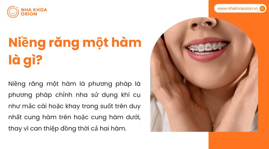 Niềng răng một hàm là gì