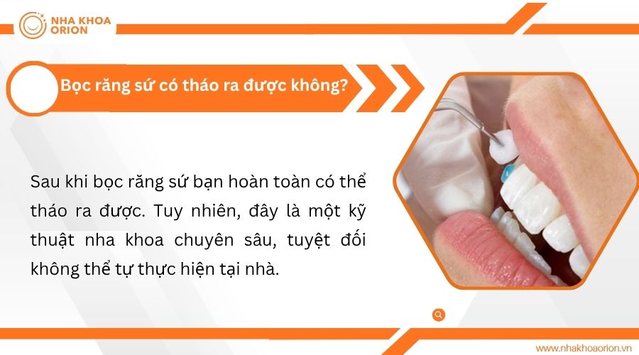 Bọc răng sứ c&oacute; th&aacute;o ra được kh&ocirc;ng