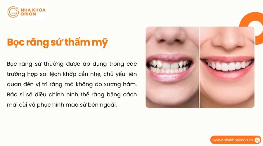 Bọc răng sứ giúp cải thiện thẩm mỹ và hỗ trợ ăn nhai ở trường hợp lệch nhẹ