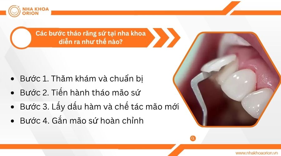 C&aacute;c bước th&aacute;o răng sứ tại nha khoa diễn ra như thế n&agrave;o