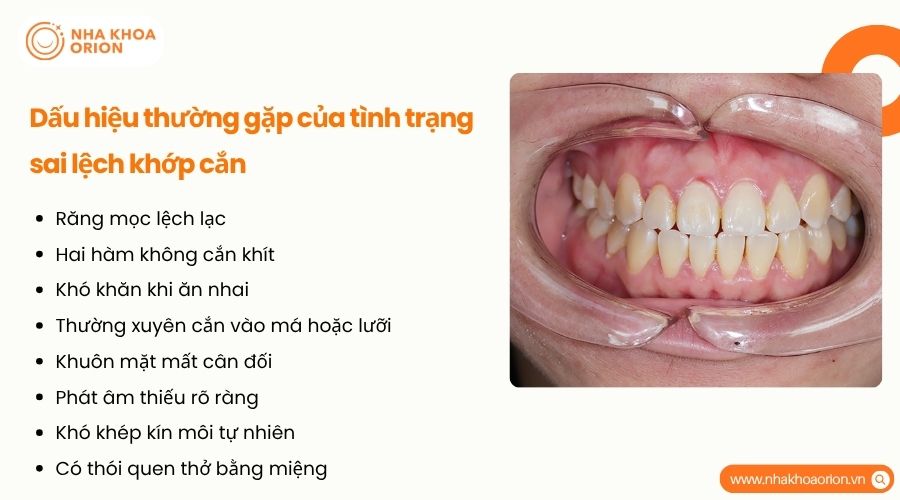 Sai lệch khớp cắn gây ảnh hưởng đến ăn nhai, phát âm và thẩm mỹ khuôn mặt