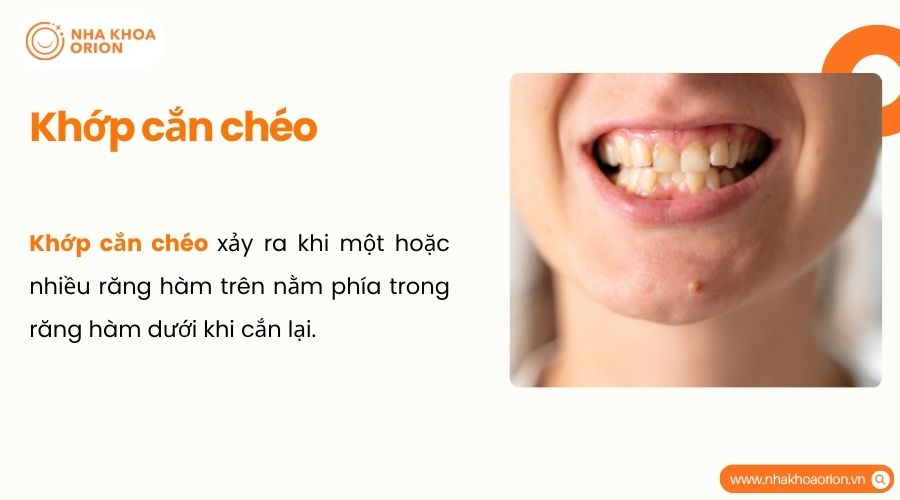 Khớp cắn chéo là tình trạng răng hàm trên nằm phía trong răng hàm dưới khi cắn lại