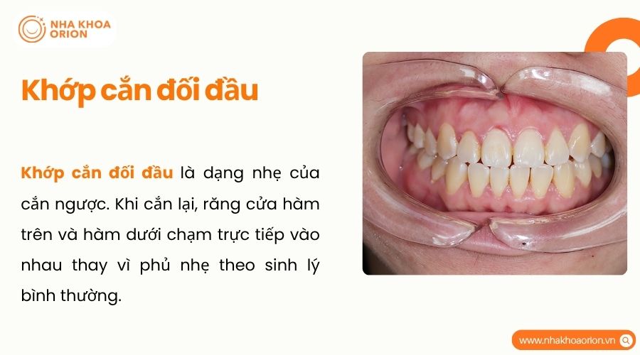 Khớp cắn đối đầu là tình trạng răng cửa hai hàm chạm trực tiếp khi cắn lại