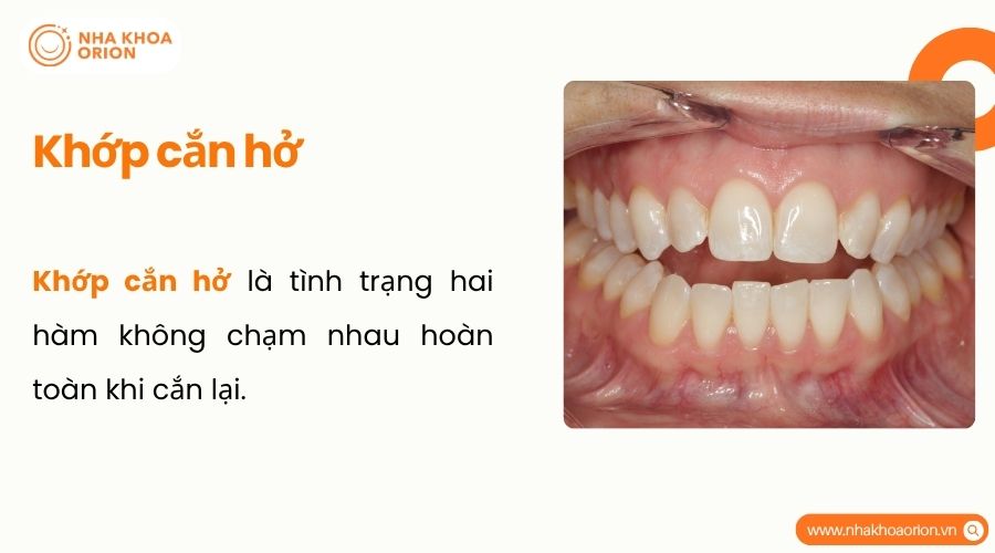 Khớp cắn hở là tình trạng hai hàm không chạm nhau hoàn toàn khi ngậm miệng