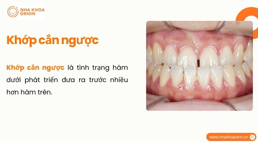Khớp cắn ngược là tình trạng hàm dưới đưa ra trước quá mức so với hàm trên