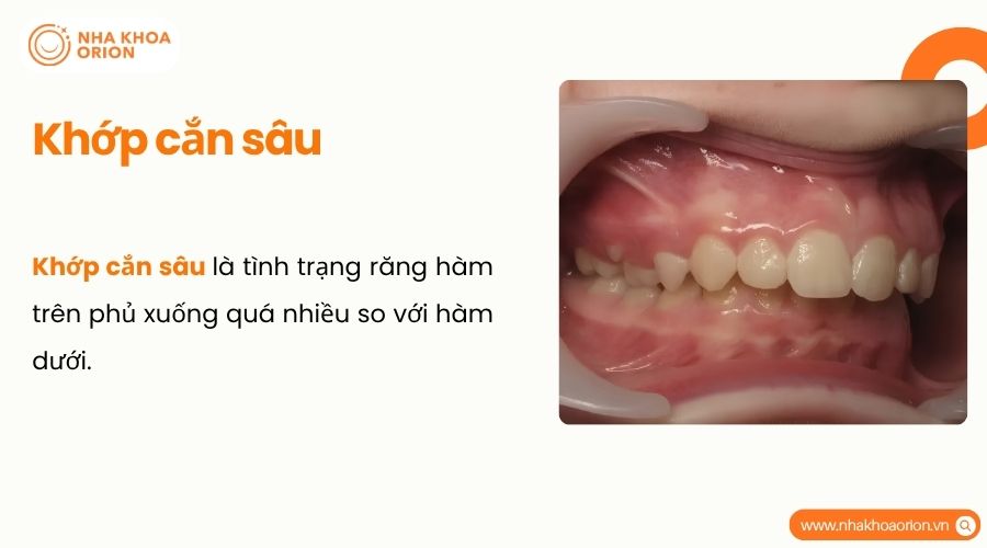 Khớp cắn sâu là tình trạng răng hàm trên che phủ răng hàm dưới quá mức bình thường