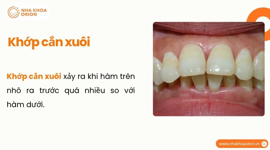 Khớp cắn xuôi là tình trạng hàm trên nhô ra trước nhiều hơn so với hàm dưới
