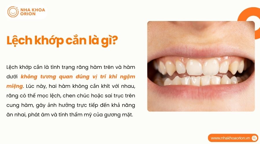 Lệch khớp cắn là gì