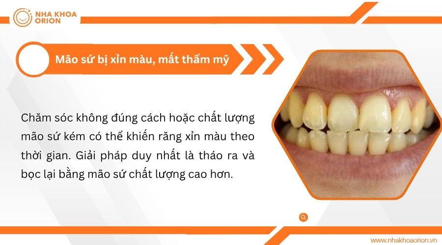 M&atilde;o sứ bị xỉn m&agrave;u, mất thẩm mỹ