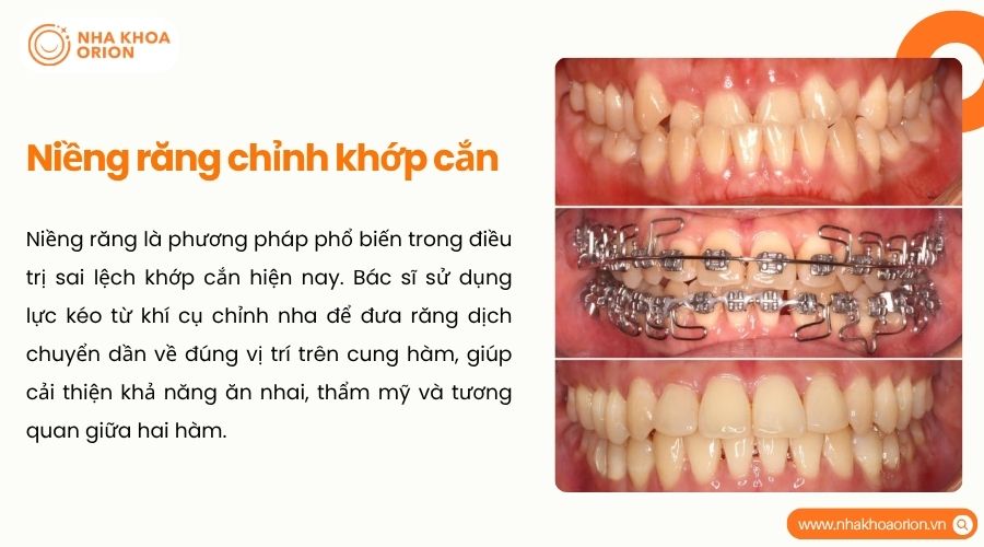 Niềng răng giúp đưa răng về đúng vị trí và cải thiện tương quan giữa hai hàm