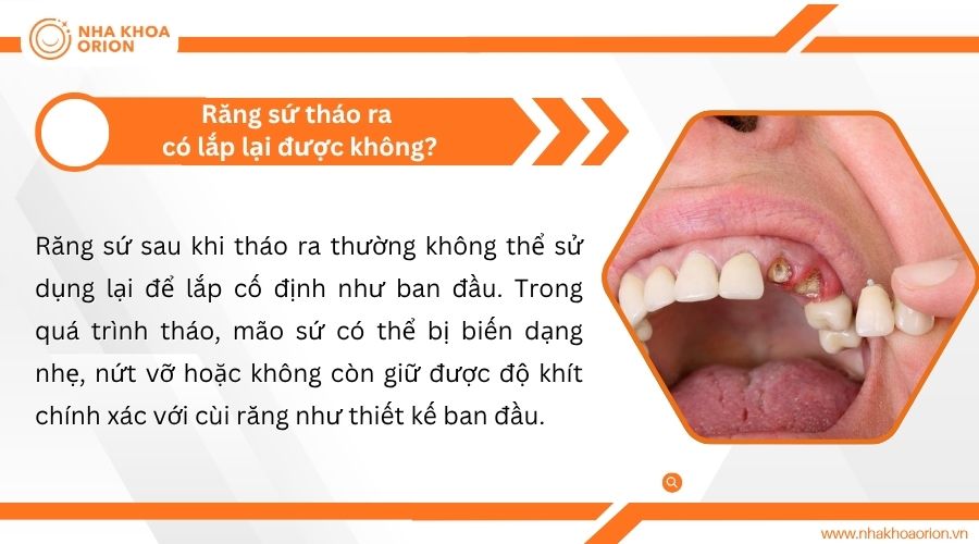 Răng sứ th&aacute;o ra c&oacute; lắp lại được kh&ocirc;ng