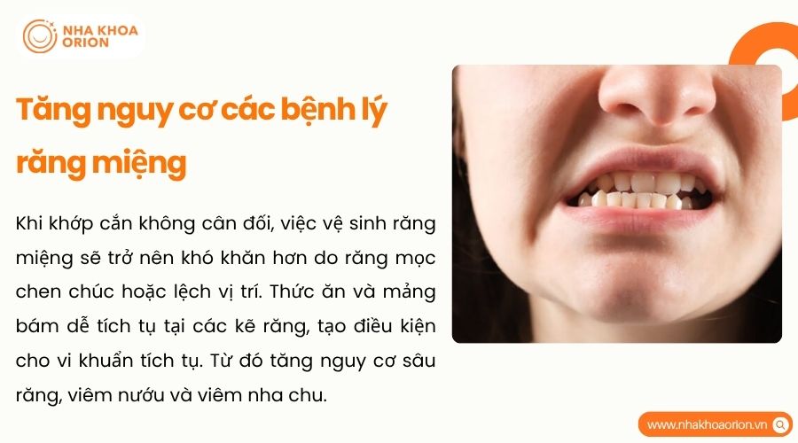 Lệch khớp cắn làm tăng nguy cơ sâu răng, viêm nướu và mòn men răng kéo dài
