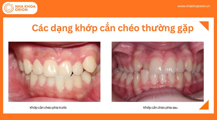 C&aacute;c dạng khớp cắn ch&eacute;o thường gặp