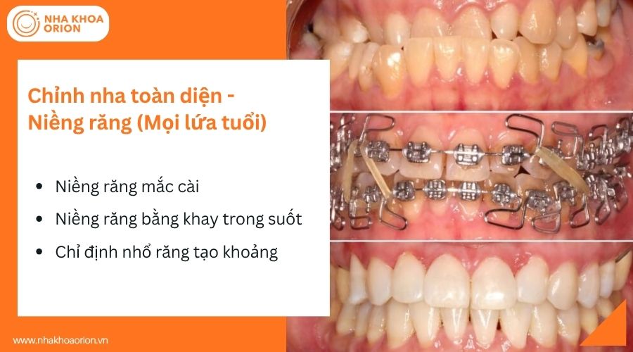 Niềng răng gi&uacute;p chỉnh khớp cắn ch&eacute;o hiệu quả ở mọi lứa tuổi
