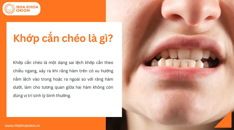 Khớp cắn ch&eacute;o l&agrave; g&igrave;