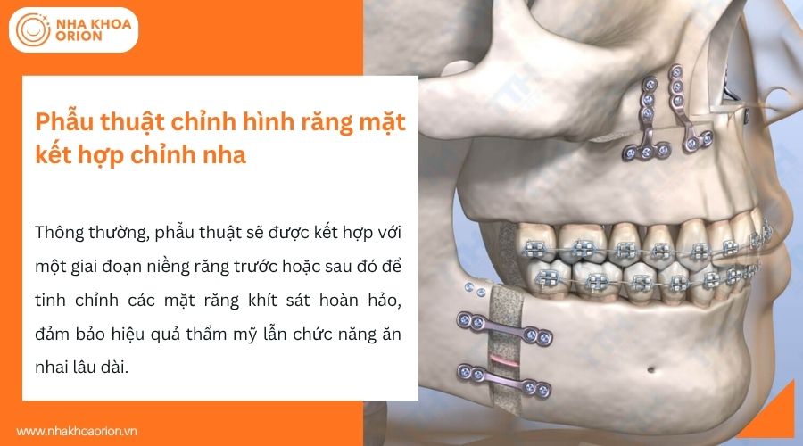 Phẫu thuật chỉnh h&igrave;nh răng mặt kết hợp chỉnh nha