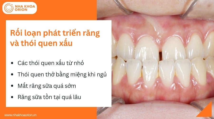 Rối loạn ph&aacute;t triển răng v&agrave; th&oacute;i quen xấu