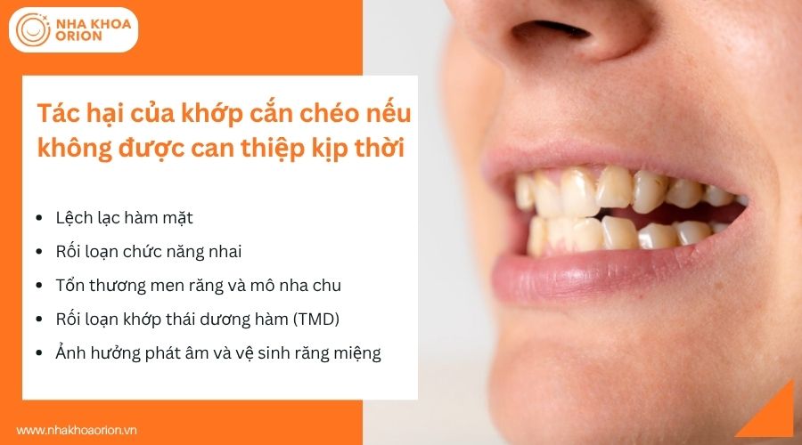 T&aacute;c hại của khớp cắn ch&eacute;o nếu kh&ocirc;ng được can thiệp kịp thời