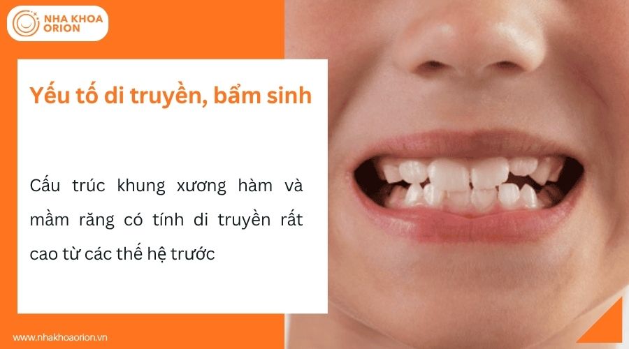 Di truyền từ gia đ&igrave;nh l&agrave; một trong những nguy&ecirc;n nh&acirc;n ch&iacute;nh g&acirc;y khớp cắn ch&eacute;o