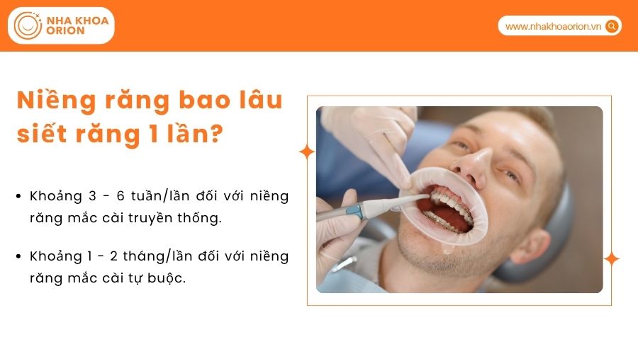 Niềng răng bao l&acirc;u siết răng 1 lần