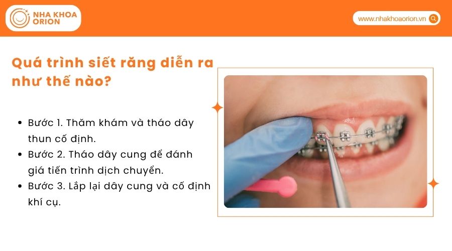 Qu&aacute; tr&igrave;nh siết răng diễn ra như thế n&agrave;o