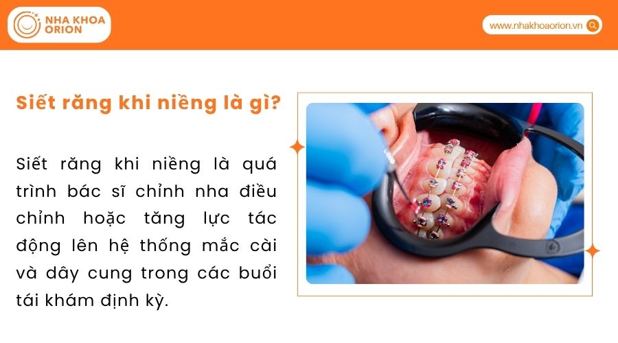 Siết răng khi niềng l&agrave; g&igrave;