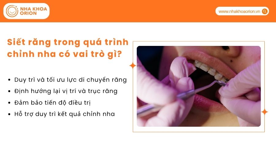 Siết răng trong qu&aacute; tr&igrave;nh chỉnh nha c&oacute; vai tr&ograve; g&igrave;