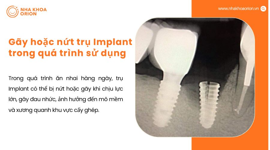 G&atilde;y hoặc nứt trụ Implant trong qu&aacute; tr&igrave;nh sử dụng