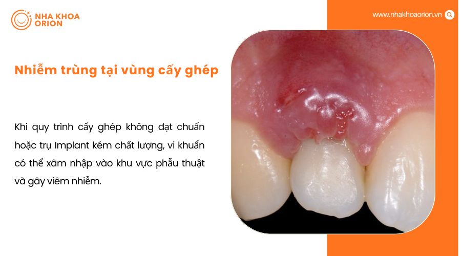 Nhiễm tr&ugrave;ng tại v&ugrave;ng cấy gh&eacute;p