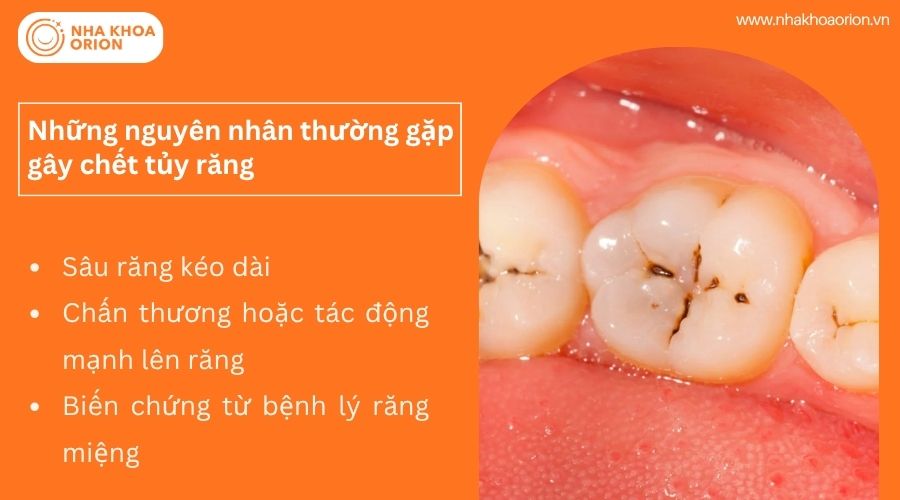 Những nguy&ecirc;n nh&acirc;n thường gặp g&acirc;y chết tủy răng