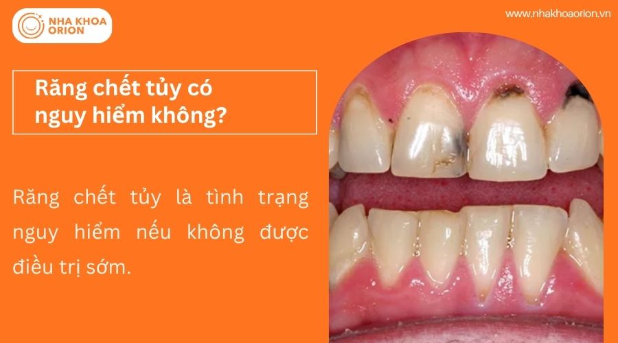 Răng chết tủy c&oacute; nguy hiểm kh&ocirc;ng?