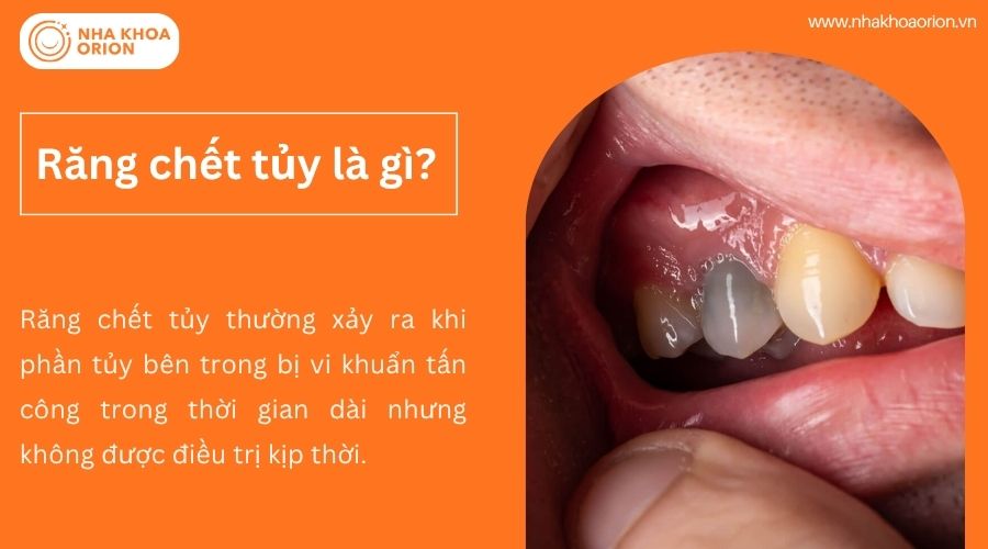 Răng chết tủy l&agrave; g&igrave;?
