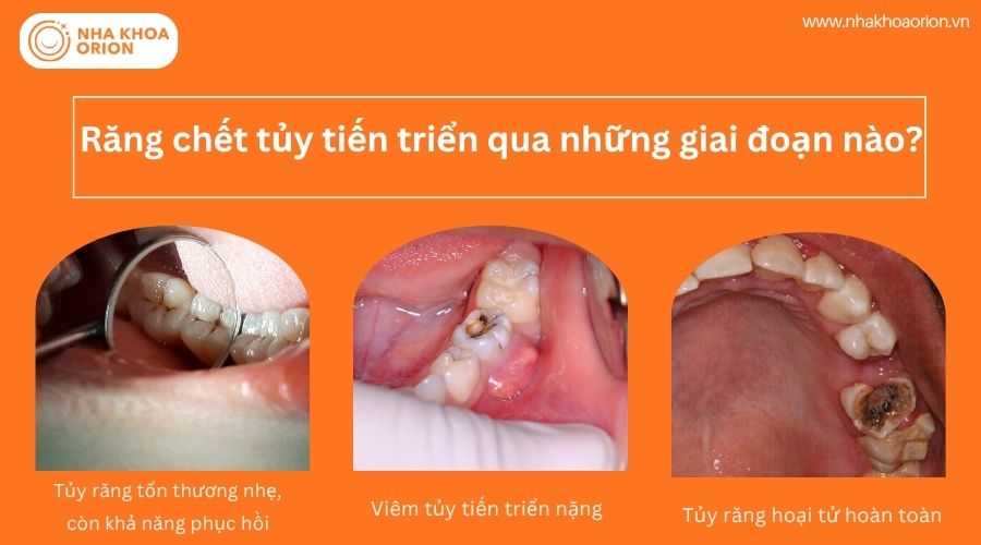 Tủy răng hoại tử ho&agrave;n to&agrave;n